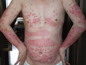 頭上長有牛皮癬治療偏方大全