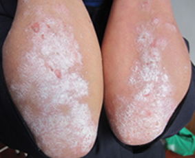 副牛皮癬會不會發展成為真的牛皮癬