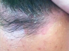 牛皮癬治療期間能拔牙嗎