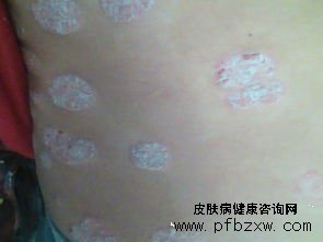 牛皮癬用什么藥治療才對癥