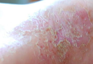 腳上長牛皮癬怎么辦才好