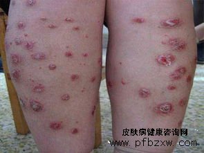 牛皮癬早期如何科學的治療