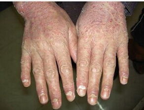 部分牛皮癬患者頭部的癥狀表現(xiàn)