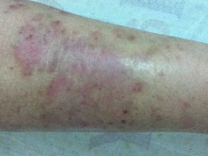 中醫治療牛皮癬的原則是什么