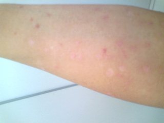 牛皮癬一個療程的治療要多少錢