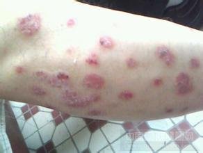 牛皮癬的并發癥怎么更好的應對