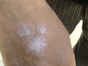 治牛皮癬用什么藥效果好不復(fù)發(fā)