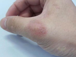 遺傳性的牛皮癬什么時候發病