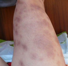 手部患了牛皮癬應該如何護理和治療