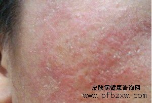 如何才能有效的阻止牛皮癬“雪花紛飛”