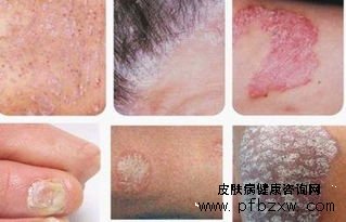 誘發(fā)牛皮癬發(fā)病加重的因素