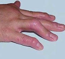 幼兒牛皮癬能不能徹底根治