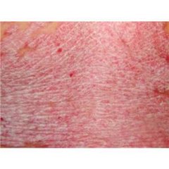 牛皮癬用什么中藥泡可以治療