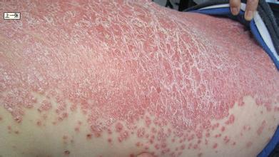 對于孕婦牛皮癬該怎樣治療