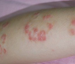 牛皮癬的并發(fā)癥會(huì)危及到生命嗎