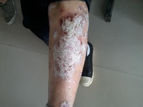 牛皮癬的發(fā)病和日常的穿衣有關(guān)嗎