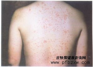 牛皮癬軟膏有副作用嗎