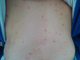 牛皮癬患者長期在電腦前工作影響病情嗎