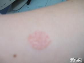 關(guān)注尋常型牛皮癬發(fā)病初期的癥狀