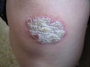 女性牛皮癬怎么治好的比較快