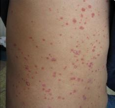 牛皮癬患者不能空腹吃哪些東西