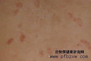 老年牛皮癬患者如何護理好的快