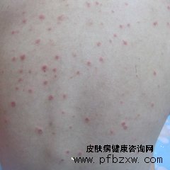 牛皮癬的發病都是尋常型的嗎