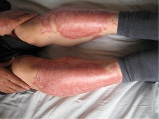 紅外線治療牛皮癬有效果嗎