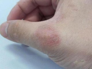 多年頑固牛皮癬還有根治的可能性嗎