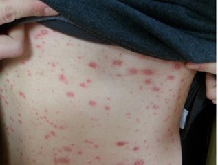 患上牛皮癬如何全面有效的治療