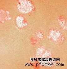 社會因素對牛皮癬患者疾病的影響