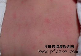 牛皮癬突然出現(xiàn)潰瘍怎么處理