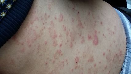 冬季牛皮癬容易反復發作怎么治