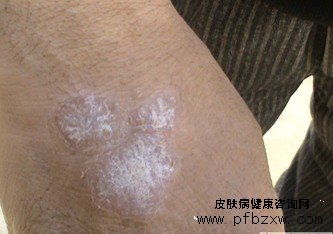 牛皮癬的發病會影響血液的健康嗎