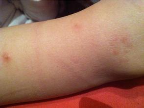 日光浴對牛皮癬病情的恢復有幫助嗎