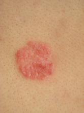 牛皮癬永久治愈的好方法