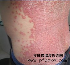 牛皮癬患者可以使用薄荷止癢嗎