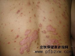 什么樣的粥比較適合牛皮癬患者食用