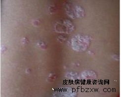 牛皮癬患者能用牛奶護膚嗎