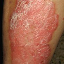 治療牛皮癬怎樣正確用藥效果最好