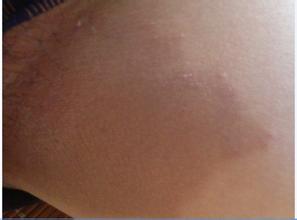 點滴型銀屑病發(fā)病的病因都有什么