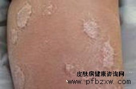 重癥牛皮癬患者如何更好的治療