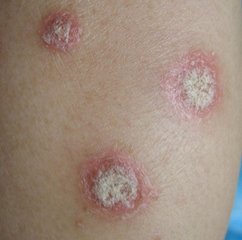 為啥天氣變暖牛皮癬病情減輕了