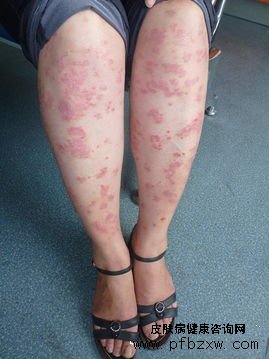 牛皮癬患者熬夜會導(dǎo)致病情反復(fù)嗎