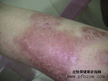 補充足夠的水分能預防牛皮癬疾病嗎