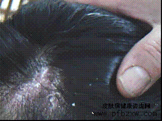 牛皮癬患者為什么不能使用西藥治療