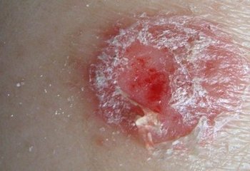 牛皮癬復(fù)發(fā)該如何醫(yī)治才好呢